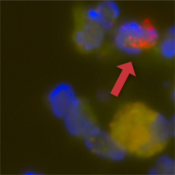 Metafer and XRNA Probes Reveal Incidence for Italy's Covid-19 Patient Zero Metafer and XRNA Probes Reveal Incidence for Italy's Covid-19 Patient Zero